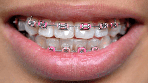 Metal Braces at Cedarbaum in Orthodontics Flemington NJ