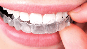 Invisalign Photo at Cedarbaum Orthodontics in Flemington NJ